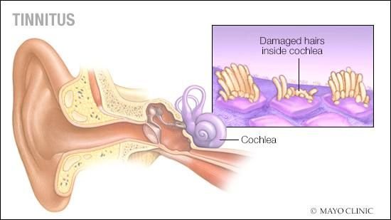 Guide on Tinnitus Cure in Pakistan and ASSR Hearing Test Price