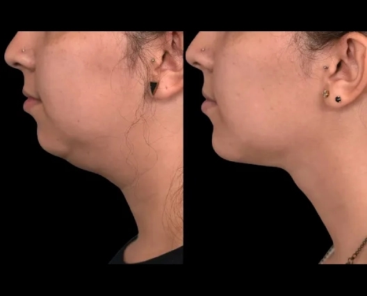 The Long-Term Results of Double chin removal Surgery in dubai