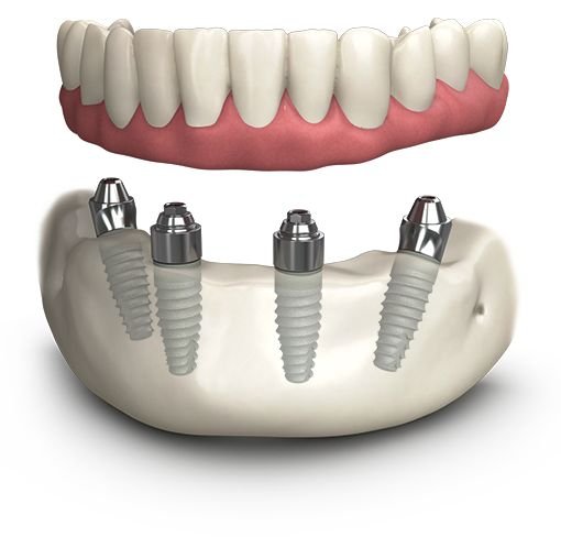 How Much Do All-on-4 Dental Implants Cost in My Area?