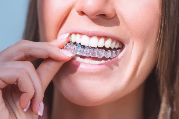 Invisalign i7 for Fast and Easy Treatment of Mild Orthodontic Issues