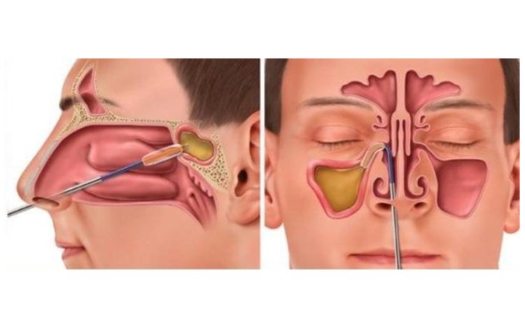 Balloon Sinuplasty: A Minimally Invasive Option for Chronic Sinusitis