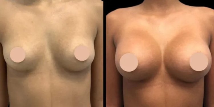 Safety First: How the Best Breast Augmentation Surgeons in Dubai Prioritize Your Well-being