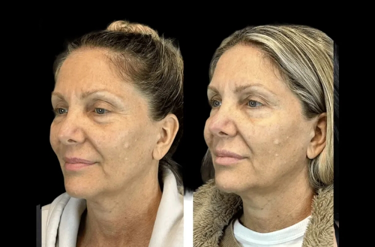 The Benefits of Botox Treatments in Dubai: Why It’s More Than Just Wrinkle Reduction