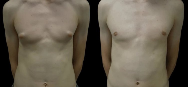 Gynecomastia in Dubai: Everything You Need to Know Before Surgery