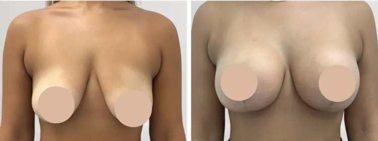 Breast Lift Surgery in dubai: Does It Help with Back Pain and Discomfort?