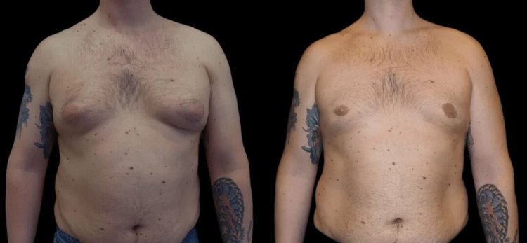 Gynecomastia Surgery in dubai: How to Maintain Your Results