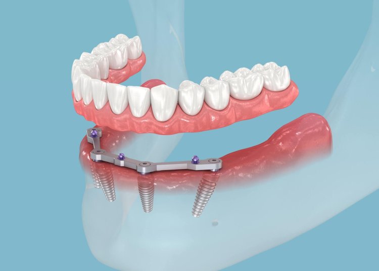 What Are the Benefits of Dental Implants Over Dentures?