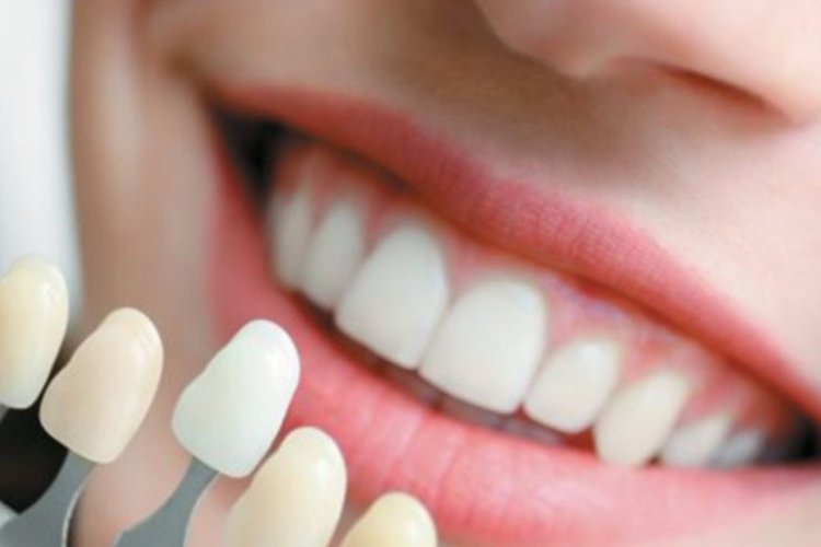 Cosmetic Dental Whitening: The Ultimate Solution for Stained Teeth