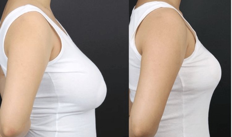 Achieve Comfort & Confidence with Breast Reduction in Dubai